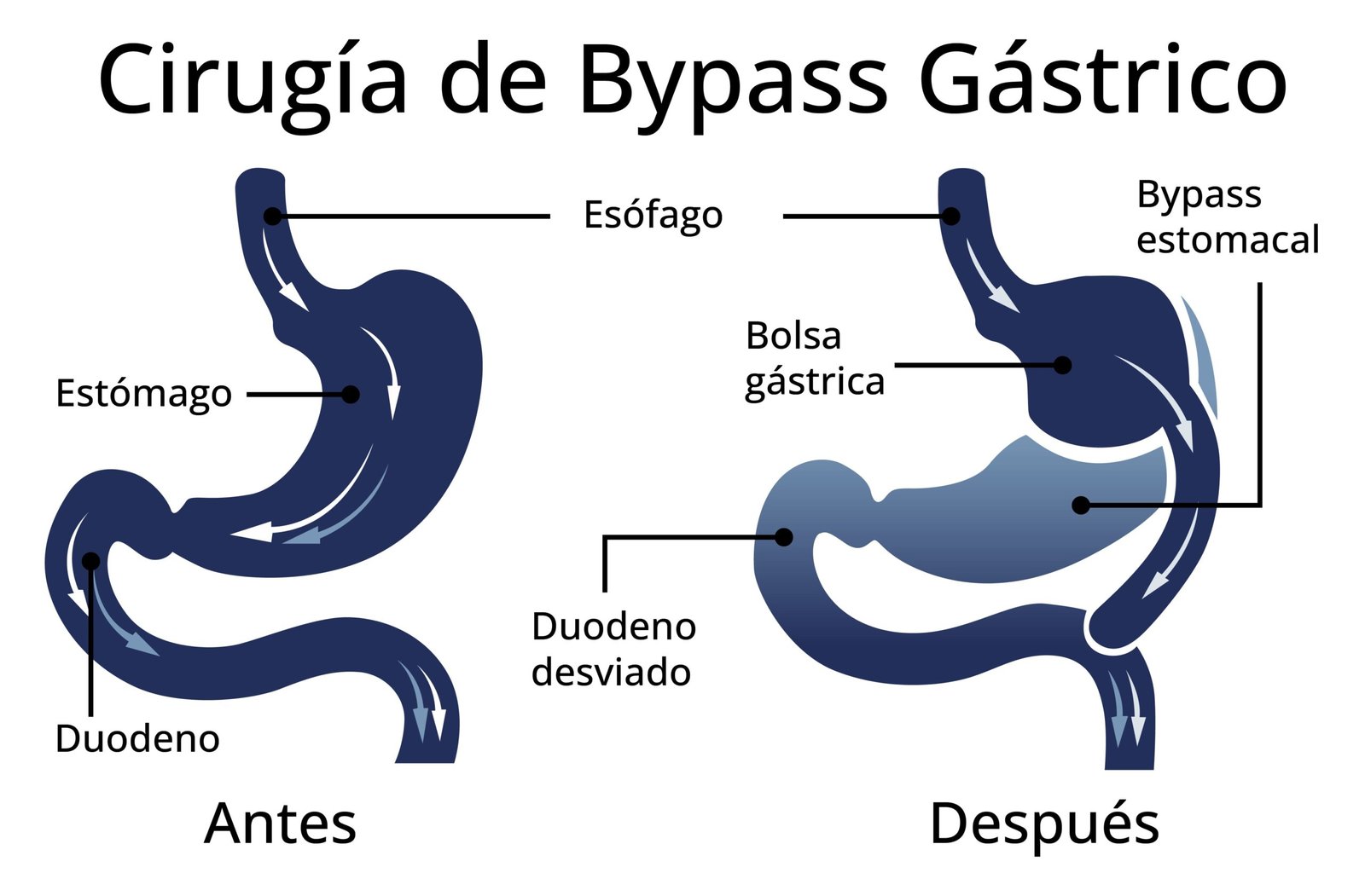 Cirugía_bariatrica
